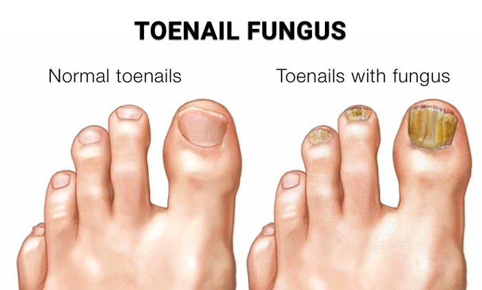 Castor-Oil-Benefits-Toenail-Fungus