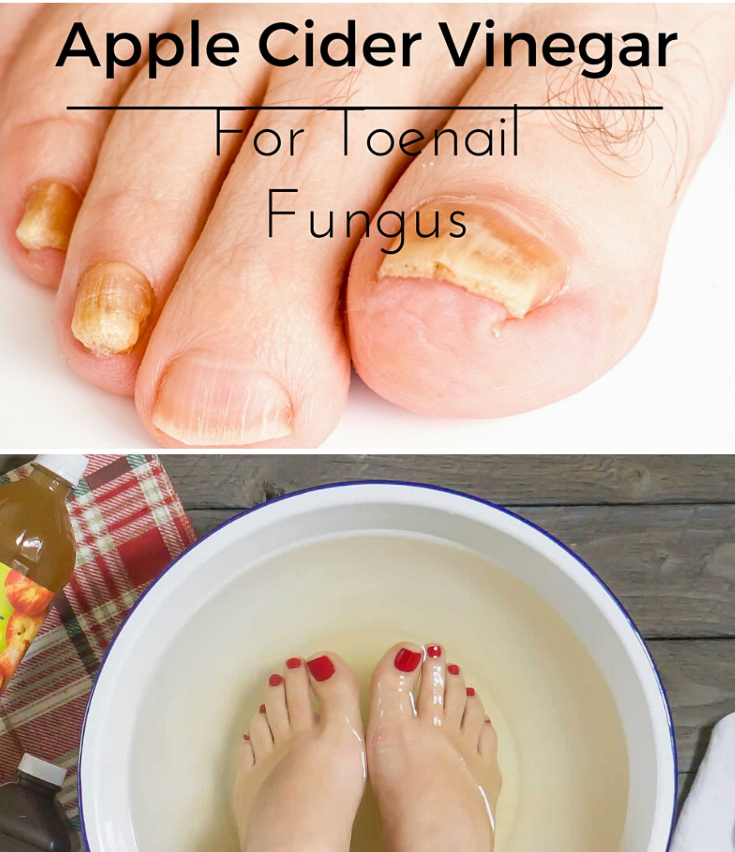 Apple-cider-vinegar-for-nail-fungas