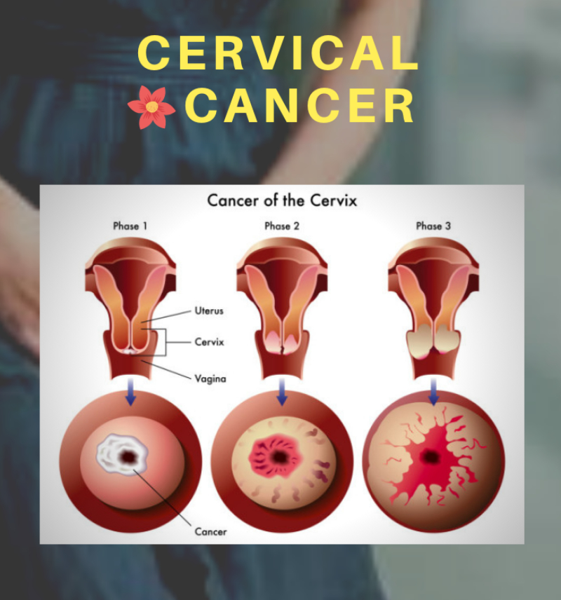 CERVICAL-CANCER
