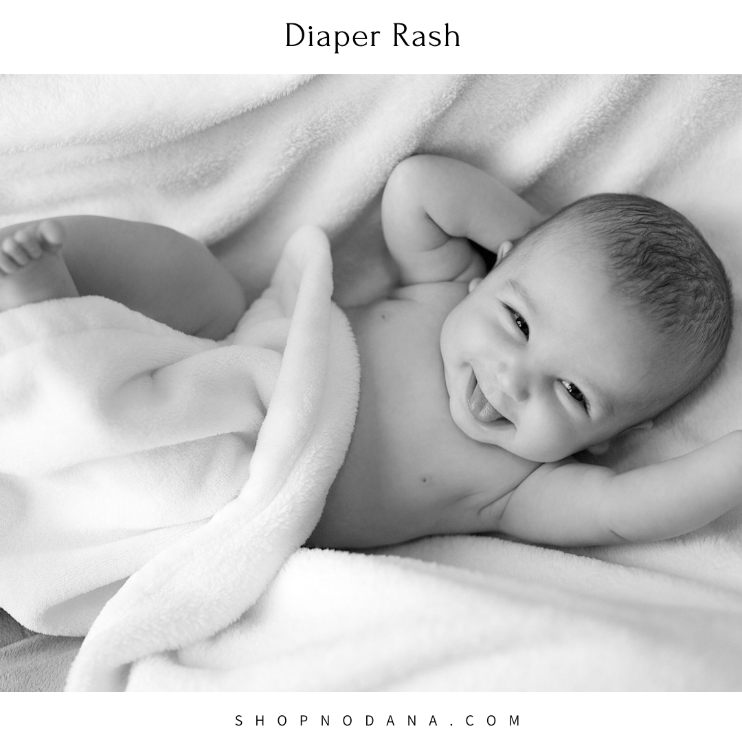 Common baby illnesses- Diaper Rash
