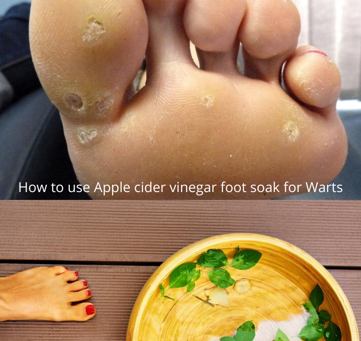 How-to-use-Apple-cider-vinegar-foot-soak-for-Warts