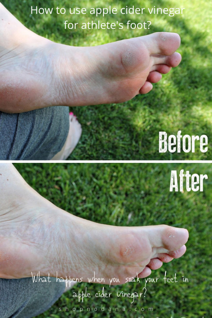 Apple Cider Vinegar Foot SoakWhat happens if you soak your feet in ACV