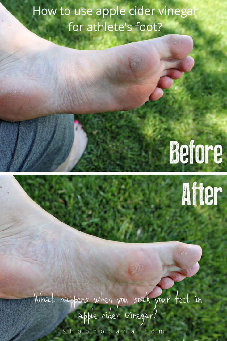 How-to-use-apple-cider-vinegar-for-athletes-foot