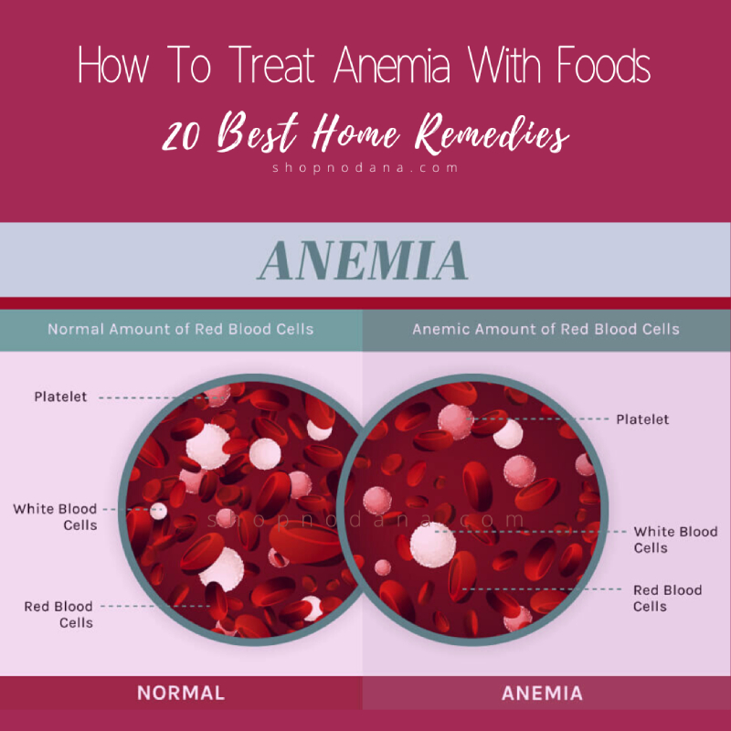 How-To-Treat-Anemia-With-Foods-20-Best-Home-Remedies