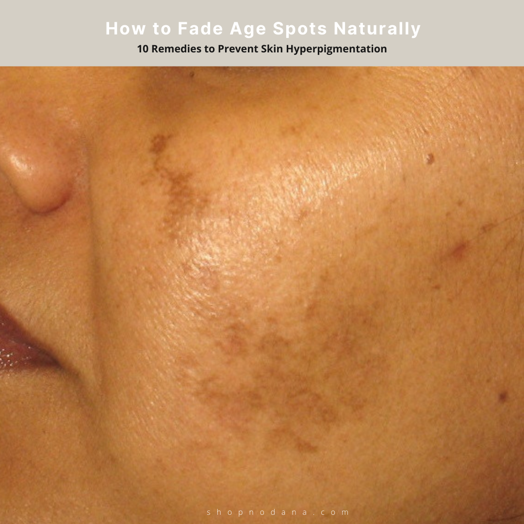 How to Fade Age Spots Naturally 