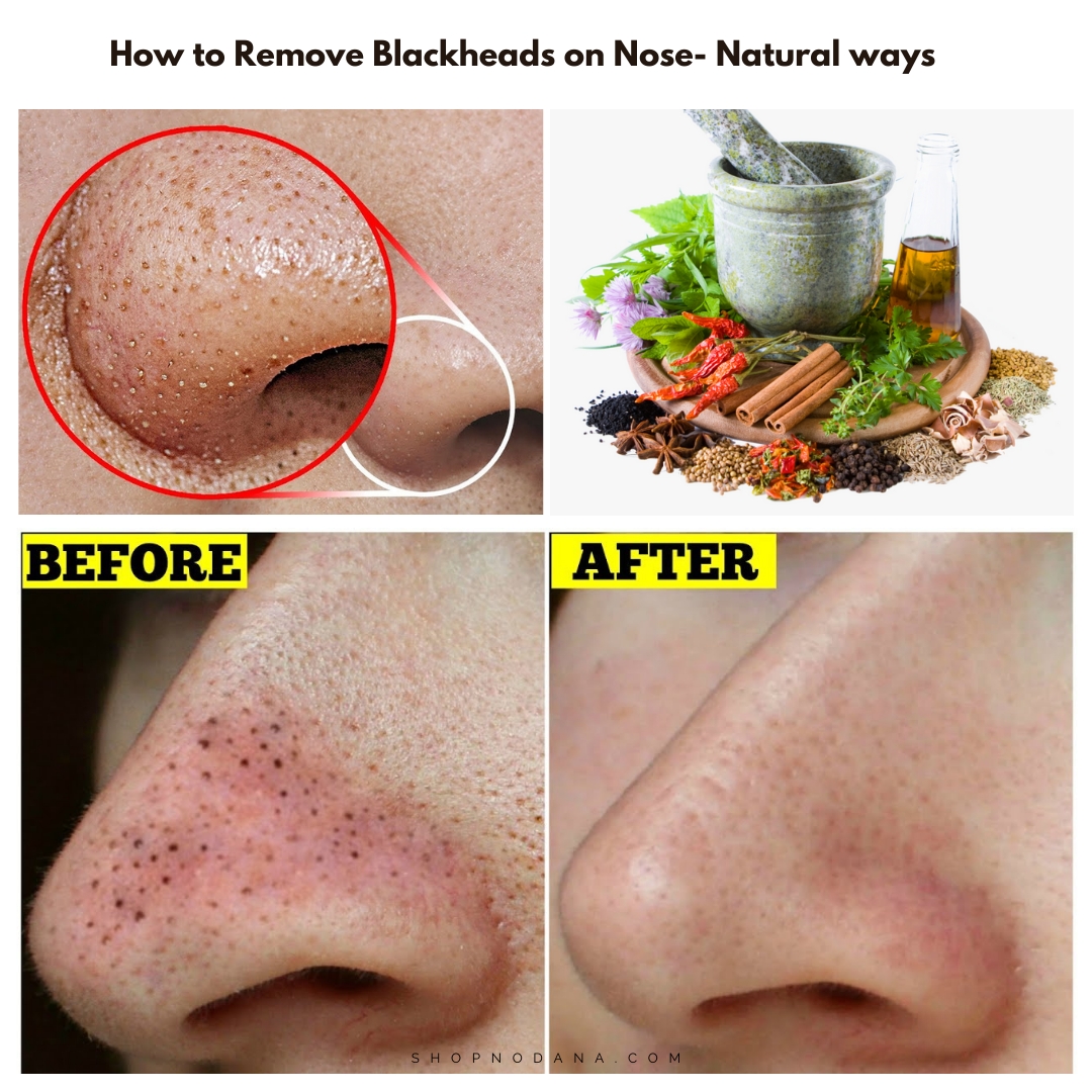 How to Remove Blackheads on Nose- Natural ways