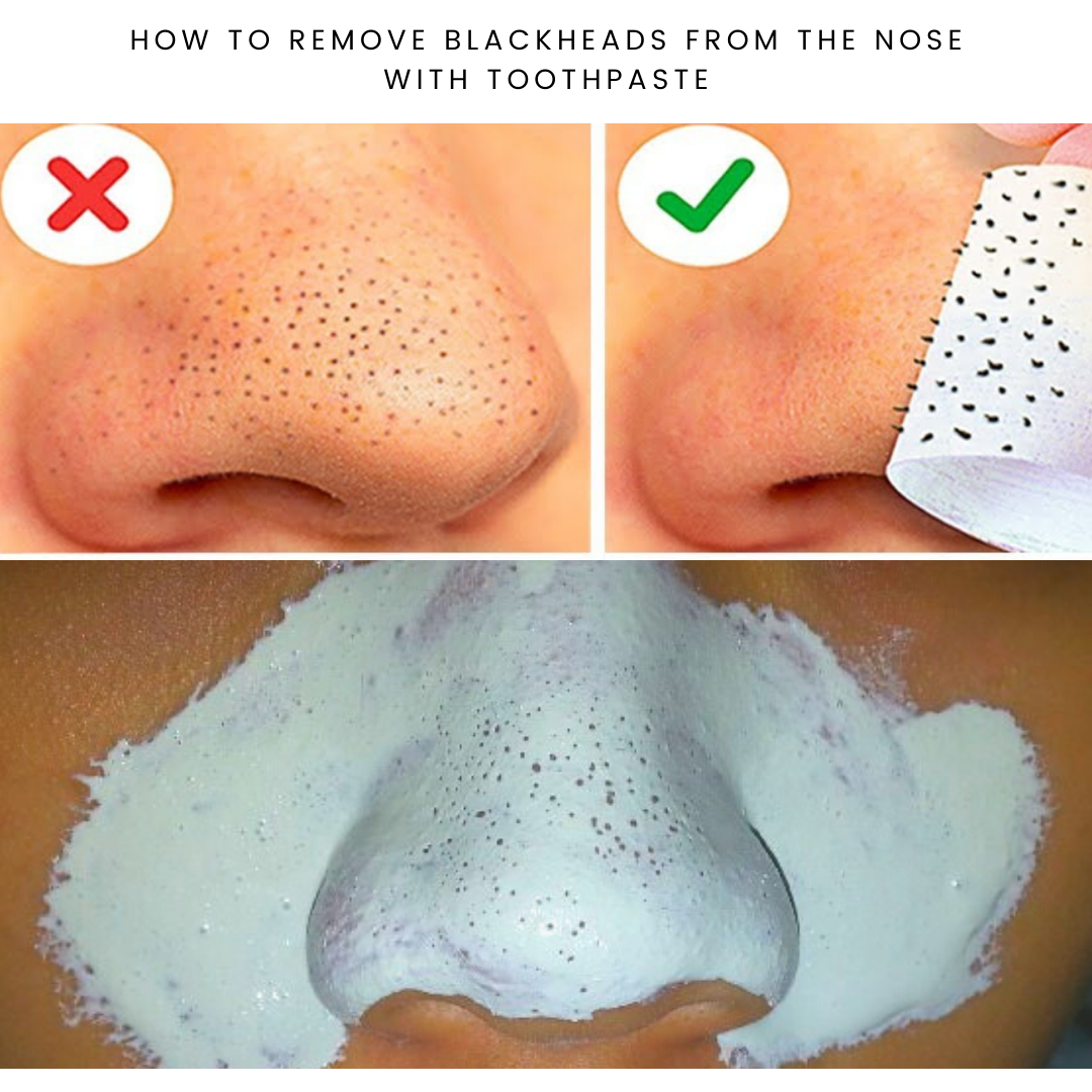 How to Remove Blackheads on Nose with toothpaste and salt